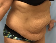 Tummy Tuck Before Photo by Julia Spears, MD, FACS; ,  - Case 50538