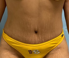 Liposuction After Photo by Julia Spears, MD, FACS; ,  - Case 50540