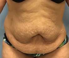 Liposuction Before Photo by Julia Spears, MD, FACS; ,  - Case 50540