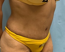 Liposuction After Photo by Julia Spears, MD, FACS; ,  - Case 50540