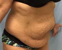 Liposuction Before Photo by Julia Spears, MD, FACS; ,  - Case 50540