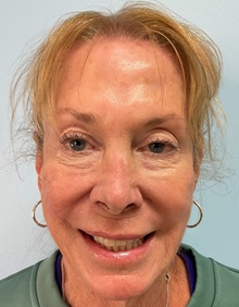 Dermal Fillers After Photo by Julia Spears, MD, FACS; ,  - Case 50560