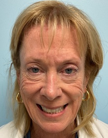 Dermal Fillers Before Photo by Julia Spears, MD, FACS; ,  - Case 50560