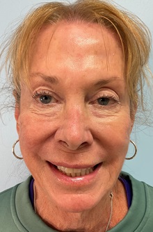 Botulinum Toxin After Photo by Julia Spears, MD, FACS; ,  - Case 50558