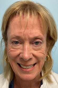 Botulinum Toxin Before Photo by Julia Spears, MD, FACS; ,  - Case 50558