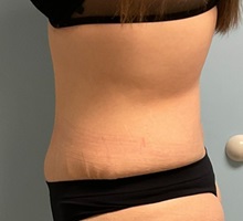 Liposuction After Photo by Julia Spears, MD, FACS; ,  - Case 50563