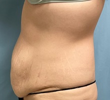 Liposuction Before Photo by Julia Spears, MD, FACS; ,  - Case 50563