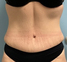 Liposuction After Photo by Julia Spears, MD, FACS; ,  - Case 50563