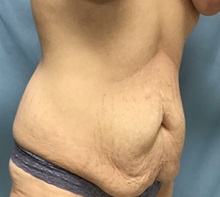 Liposuction Before Photo by Julia Spears, MD, FACS; ,  - Case 50563