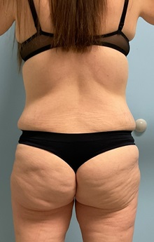 Liposuction After Photo by Julia Spears, MD, FACS; ,  - Case 50563