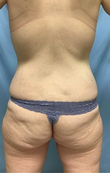 Liposuction Before Photo by Julia Spears, MD, FACS; ,  - Case 50563