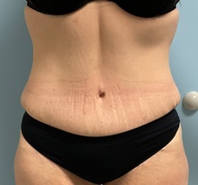 Tummy Tuck After Photo by Julia Spears, MD, FACS; ,  - Case 50562