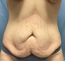 Tummy Tuck Before Photo by Julia Spears, MD, FACS; ,  - Case 50562
