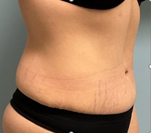 Tummy Tuck After Photo by Julia Spears, MD, FACS; ,  - Case 50562