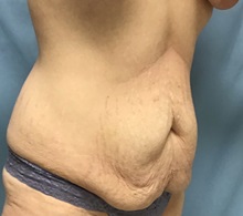 Tummy Tuck Before Photo by Julia Spears, MD, FACS; ,  - Case 50562