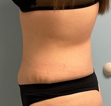 Tummy Tuck After Photo by Julia Spears, MD, FACS; ,  - Case 50562