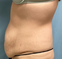Tummy Tuck Before Photo by Julia Spears, MD, FACS; ,  - Case 50562