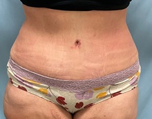 Liposuction After Photo by Julia Spears, MD, FACS; ,  - Case 50567