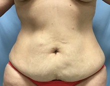 Liposuction Before Photo by Julia Spears, MD, FACS; ,  - Case 50567