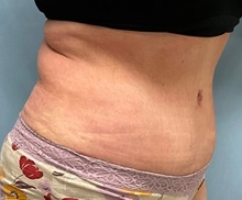 Liposuction After Photo by Julia Spears, MD, FACS; ,  - Case 50567