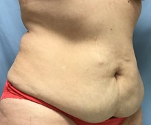 Liposuction Before Photo by Julia Spears, MD, FACS; ,  - Case 50567
