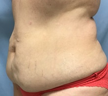 Liposuction Before Photo by Julia Spears, MD, FACS; ,  - Case 50567