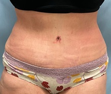 Tummy Tuck After Photo by Julia Spears, MD, FACS; ,  - Case 50566