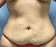 Tummy Tuck Before Photo by Julia Spears, MD, FACS; ,  - Case 50566
