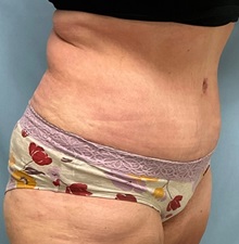 Tummy Tuck After Photo by Julia Spears, MD, FACS; ,  - Case 50566