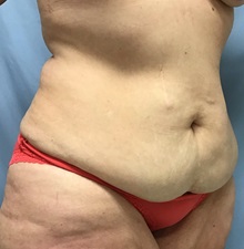 Tummy Tuck Before Photo by Julia Spears, MD, FACS; ,  - Case 50566