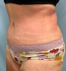 Tummy Tuck After Photo by Julia Spears, MD, FACS; ,  - Case 50566