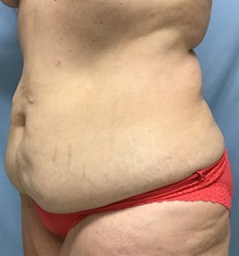 Tummy Tuck Before Photo by Julia Spears, MD, FACS; ,  - Case 50566