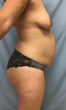 Liposuction Before Photo by Julia Spears, MD, FACS; ,  - Case 50569