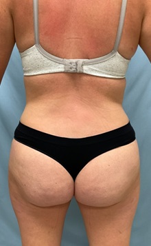 Liposuction After Photo by Julia Spears, MD, FACS; ,  - Case 50569