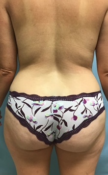 Liposuction Before Photo by Julia Spears, MD, FACS; ,  - Case 50569