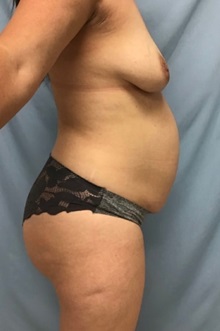 Tummy Tuck Before Photo by Julia Spears, MD, FACS; ,  - Case 50568