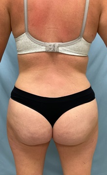 Tummy Tuck After Photo by Julia Spears, MD, FACS; ,  - Case 50568