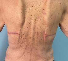 Body Contouring After Photo by Julia Spears, MD, FACS; ,  - Case 50570