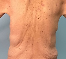 Body Contouring Before Photo by Julia Spears, MD, FACS; ,  - Case 50570