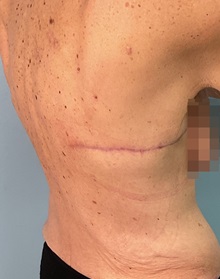 Body Contouring After Photo by Julia Spears, MD, FACS; ,  - Case 50570