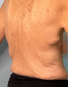 Body Contouring Before Photo by Julia Spears, MD, FACS; ,  - Case 50570