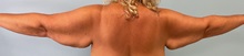 Liposuction Before Photo by Julia Spears, MD, FACS; ,  - Case 50575