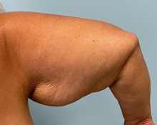 Liposuction Before Photo by Julia Spears, MD, FACS; ,  - Case 50575