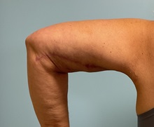 Liposuction After Photo by Julia Spears, MD, FACS; ,  - Case 50575