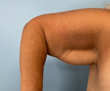 Liposuction Before Photo by Julia Spears, MD, FACS; ,  - Case 50575