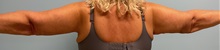 Arm Lift After Photo by Julia Spears, MD, FACS; ,  - Case 50574