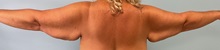 Arm Lift Before Photo by Julia Spears, MD, FACS; ,  - Case 50574