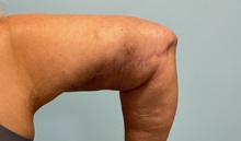 Arm Lift After Photo by Julia Spears, MD, FACS; ,  - Case 50574
