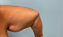 Arm Lift Before Photo by Julia Spears, MD, FACS; ,  - Case 50574