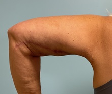 Arm Lift After Photo by Julia Spears, MD, FACS; ,  - Case 50574